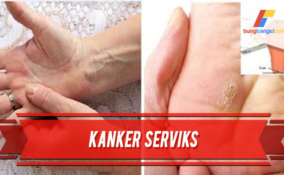 7 Tanda dan 4 Penyebab Kanker Serviks yang Perlu Diketahui Oleh Wanita
