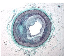 Macrography of an Coronary Artery In Disease