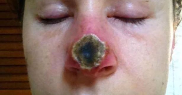 Natural Cure For Skin Cancer On Nose Natural Cure For Skin Cancer On Nose