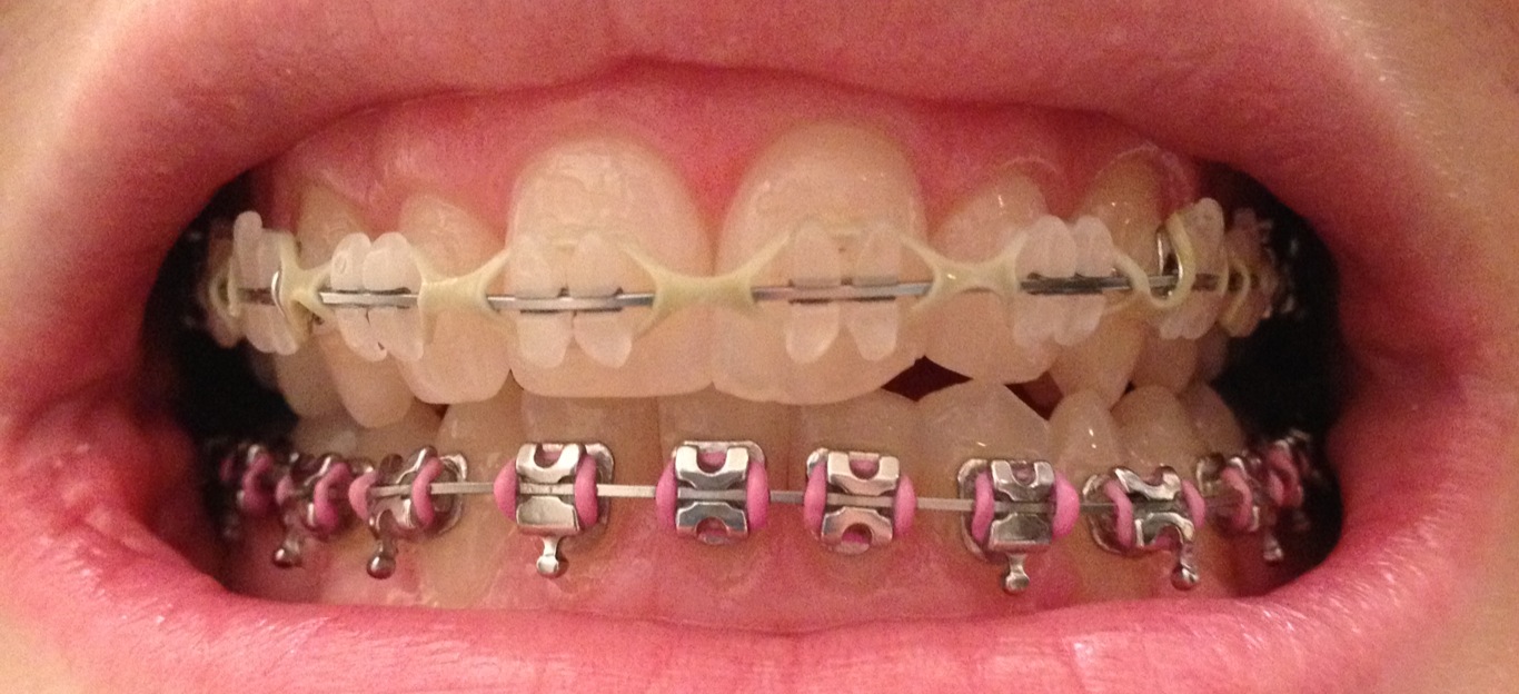 Braces Chick Elastics and Polishing.