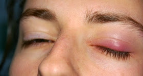 Cara mengobati Mata Bintitan