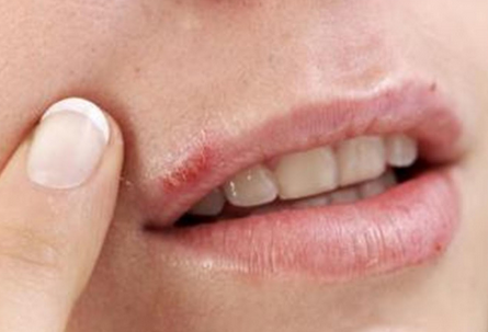 Kick Your Cold Sore / Herpes Blister FAST with These Natural Home Remedies!