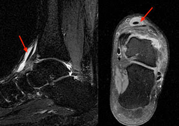 MRI Musculo-Skeletal Section: Tenosynovitis of the anterior tibial tendon
