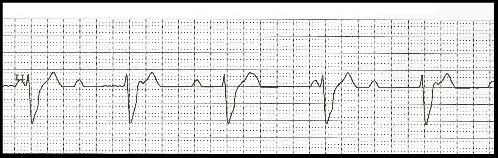 ECG Rhythm Strip Quiz 99 Heart blocks