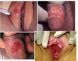 Lecet dan Gatal Disekitar Vagina Lecet dan Gatal Disekitar Vagina