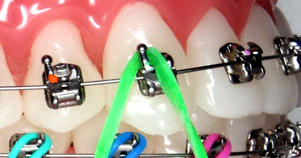 ORTHODONTIC How to Wear Orthodontic Elastic Bands Directorio