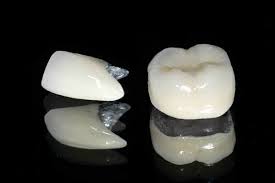 Răng sứ titan kim loại có những ưu điểm vượt trội gì?