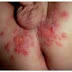 Tips Dan Cara Mengobati Herpes Di Selangkangan Dan Bokong