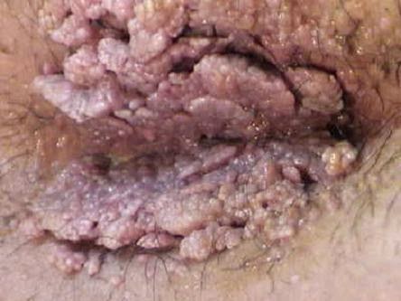 Cara Menyembuhkan Penyakit Virus Hpv