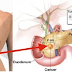 Eating a Pieces Of This Increase 20% Chance Of Pancreatic Cancer