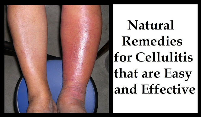 Natural Remedies For Muscle Pain In Legs Natural Remedies For Muscle Pain In Legs