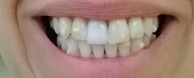Michelle's Invisalign Journey: Tray 19 & Round 1 Attachment Removal