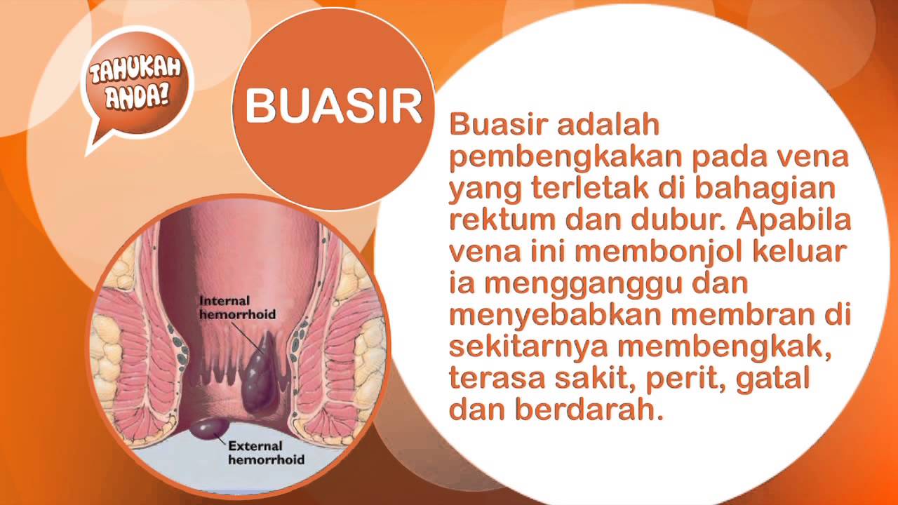 My Vitamine Shope Apakah Tanda Tanda Dan Penyebab Utama Masalah Buasir