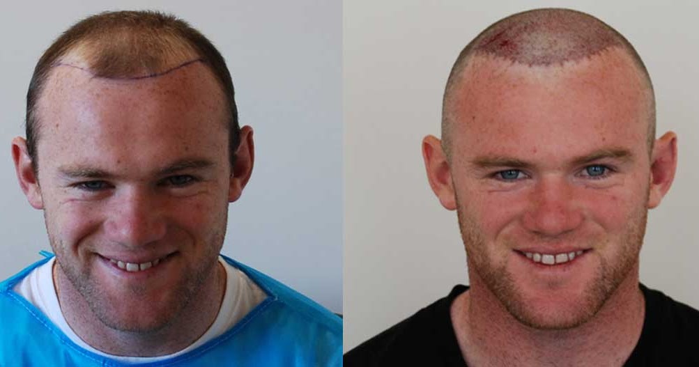 Best Hair Transplant St Louis Revive Hair Restoration St Louis MO