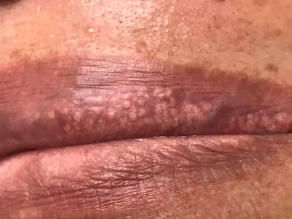 granos de fordyce en los labios como quitarlos