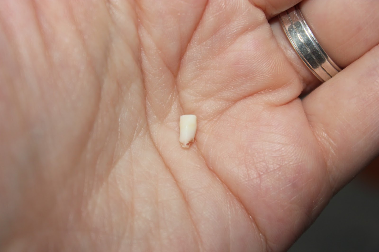 Зуб выпал без крови что значит. Выпавший передний молочный зуб. Как выглядит молочный зуб.