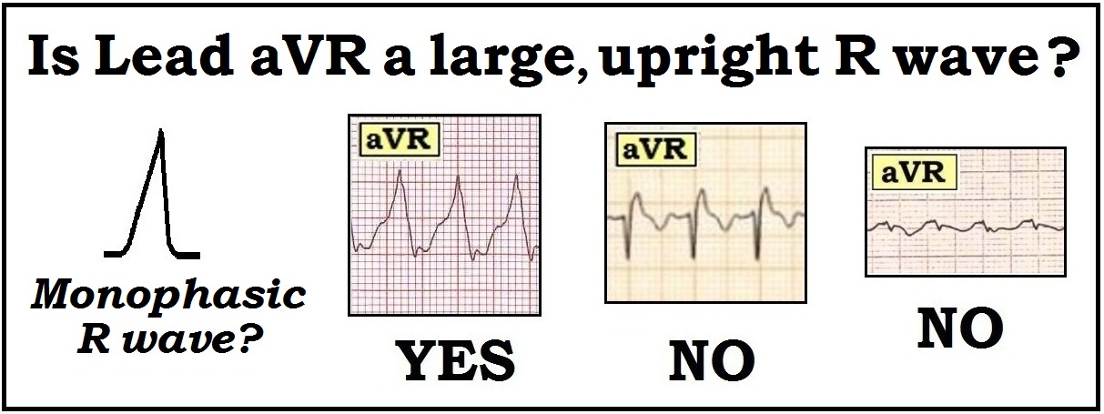 ECG Interpretation: May 2012