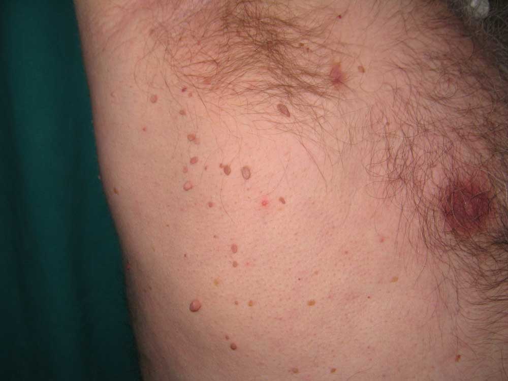 ¡Cuidado: Verrugas en las Axilas que Pican!_3 Verrugas en las axilas que pican_3