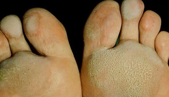 Gambar Penyakit Kaki Rayapan atau Pitted Keratolysis