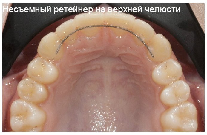 Капа ортодонтическая ретенционная. Капа при бруксизме
