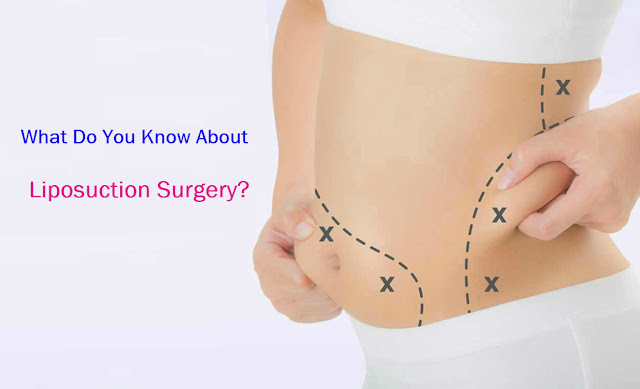 What Do You Know About Liposuction Surgery?