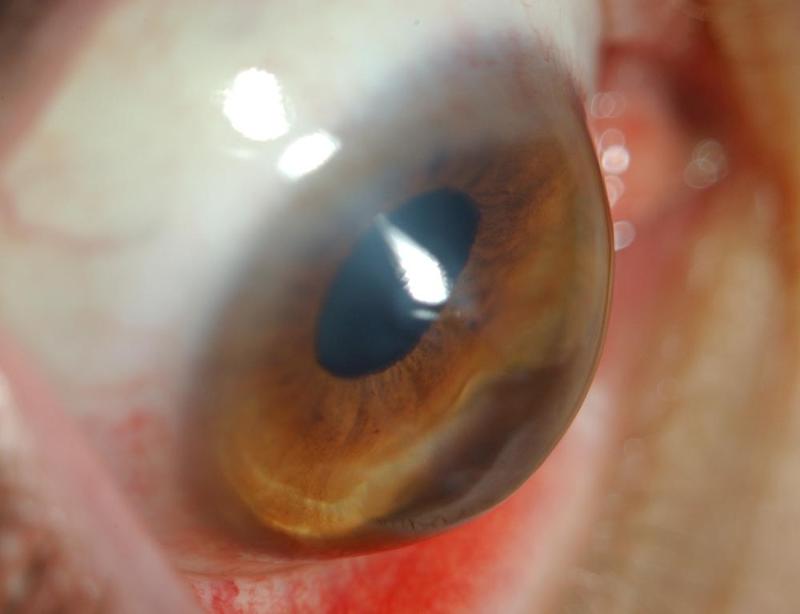 Keratoconus Is Much More Prevalent Than We Thought
