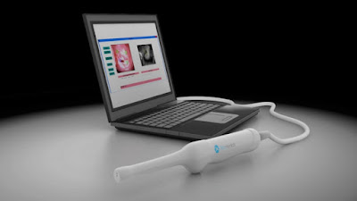 Un dispositivo de tecnología israelí puede detectar signos tempranos de cáncer de cuello uterino El dispositivo de Biop Medical, que saldrá en 2017, explora ópticamente el cuello uterino para detectar signos tempranos de cáncer, analiza las imágenes e indica dónde realizar la biopsia.