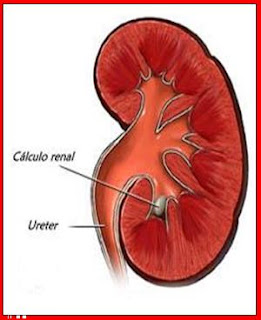 Pedra nos rins (Cálculo renal) - Causas, Sintomas e Tratamento