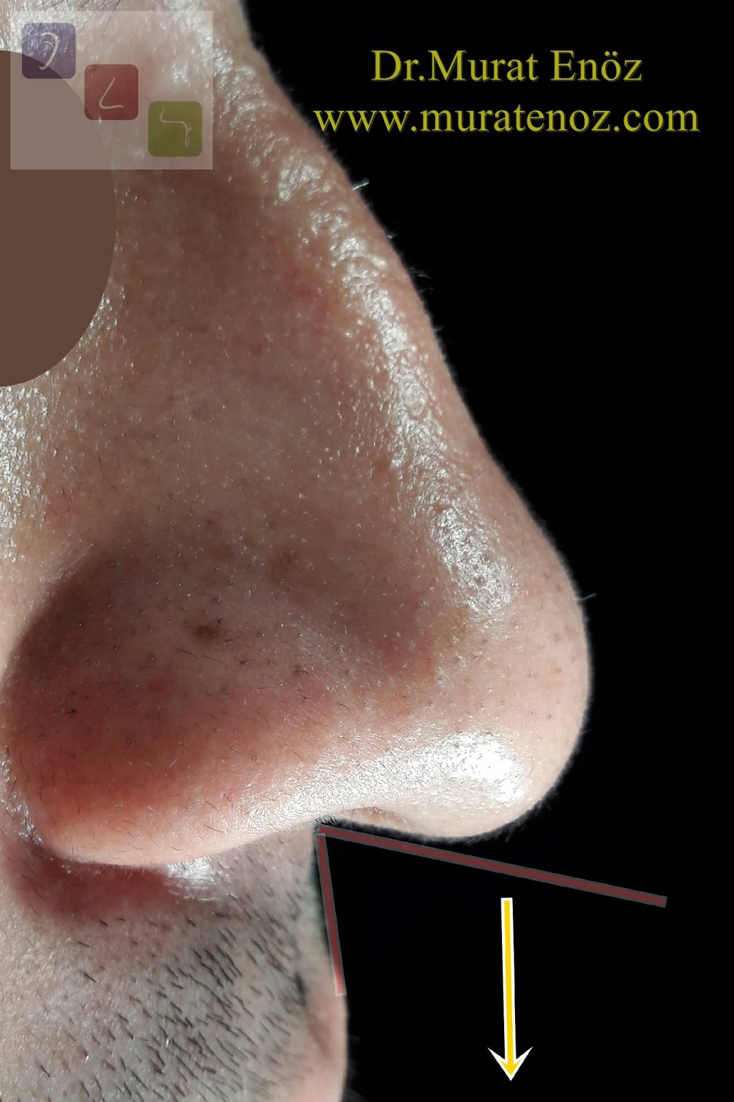 fix droppy tip nose job fix droppy tip nose job