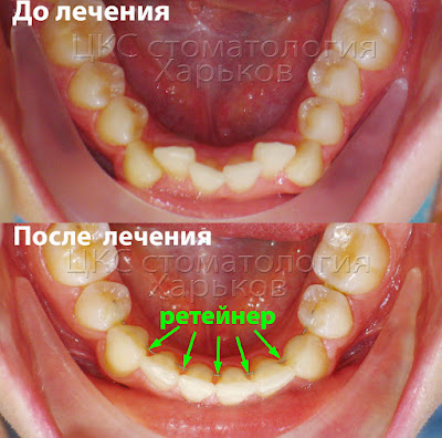 Несъемный проволочный ортодонтический ретейнер Ортодонтический ретейнер на нижней челюсти