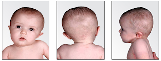 Baby with Torticollis and Plagiocephaly
