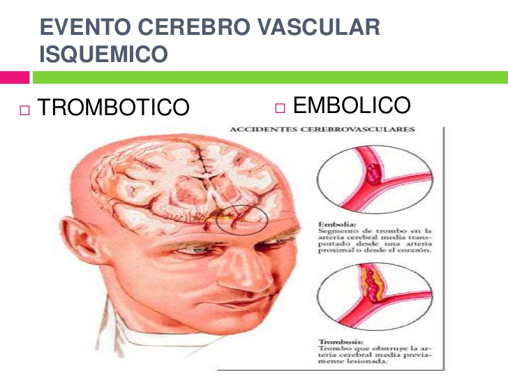ENFERMEDADES CEREBROVASCULARES ENFERMEDADES CEREBROVASCULARES