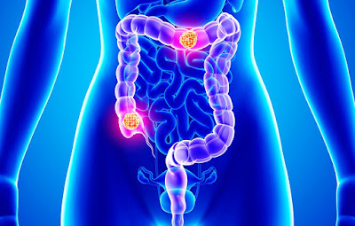 http://cancer-treatment-madurai.com/types-of-cancer-colon-and-rectal-cancer.html