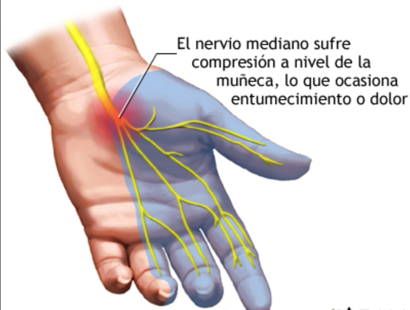 Tendinitis Muñeca Significado Emocional Conflicto Emocional De Solfa Syllable Redness