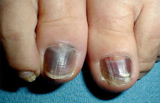 Nails care: frictional melanonychia nails diseases Nails Care: Frictional melanonychia Nails Diseases
