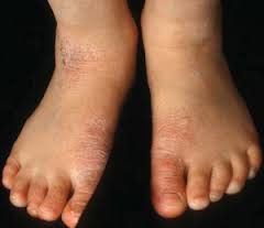 CARI OBAT GATAL KURAP DAN KUTU AIR DI KAKI TERBUKTI AMPUH CARI OBAT GATAL KURAP DAN KUTU AIR DI KAKI TERBUKTI AMPUH