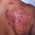 Obat Gatal Punggung