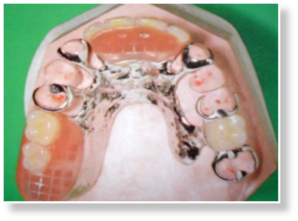 barra lingual superior conectores mayores en protesis parcial removible barra lingual superior conectores mayores en protesis parcial removible