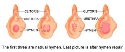 There Are Many Operations Narrowing Of The Vagina Which Aims To Increase The Strength Of The Muscles Of The Vagina And Stretching And Supporting Tissue There Are Many Operations Narrowing Of The Vagina Which Aims To Increase The Strength Of The Muscles Of The Vagina And Stretching And Supporting Tissue