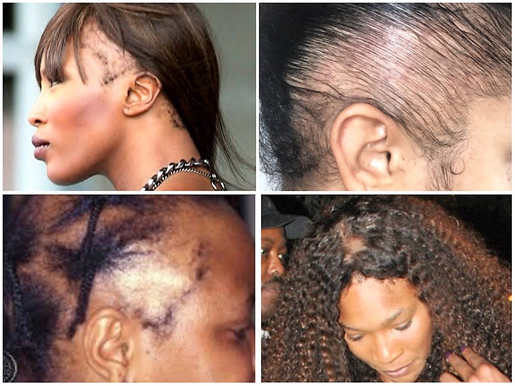 everything you need to know about traction alopecia
