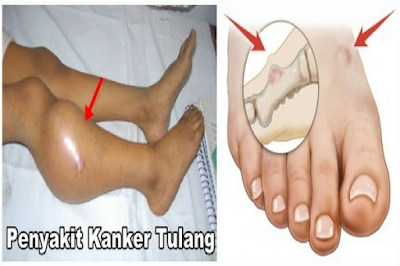 Cara Mengobati Kanker Tulang Secara Alami Tanpa Kemoterapi Cara Mengobati Kanker Tulang Secara Alami Tanpa Kemoterapi