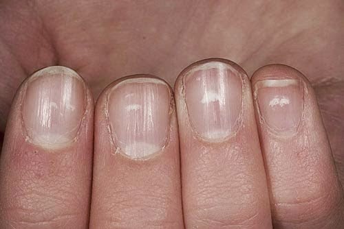 Penjelasan Arti dari Bintik Putih Pada Kuku Secara Mitos dan Ilmiah
