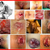 Obat Mujarab Radang Benjolan Wasir Bengkak thumbnail