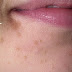 How to Remove the Small Warts Using a Single Ingredient