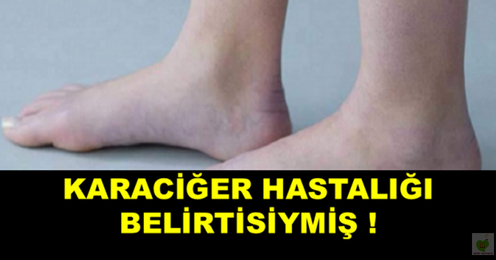 karaciger kanserinin belirtisiymis eger sizde de varsa hemen doktora gidin