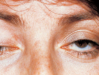 droopy eyes