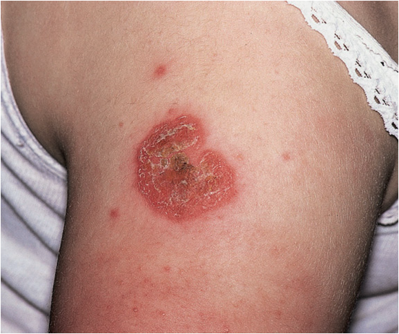 non bullous impetigo