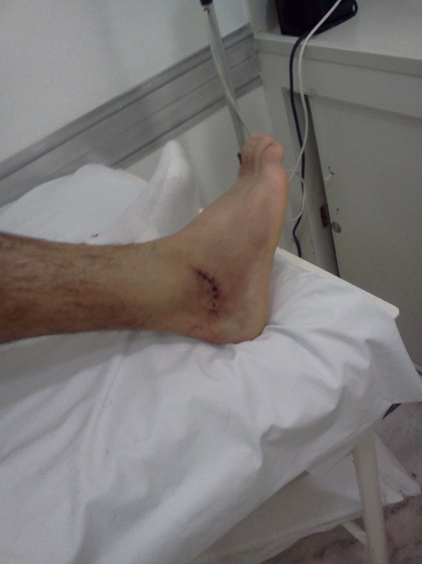 HomerPesca: Cirurgia no Tornozelo! :D