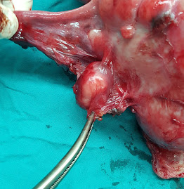 Right round ligament fibroid