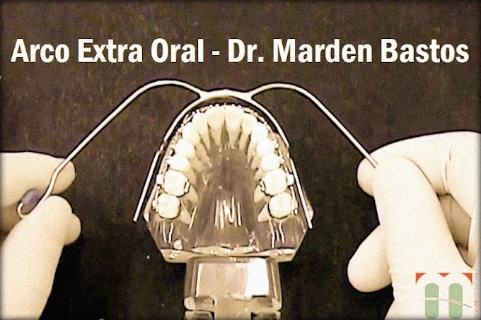 ORTODONTIA: Arco Extra Oral - Dr. Marden Bastos